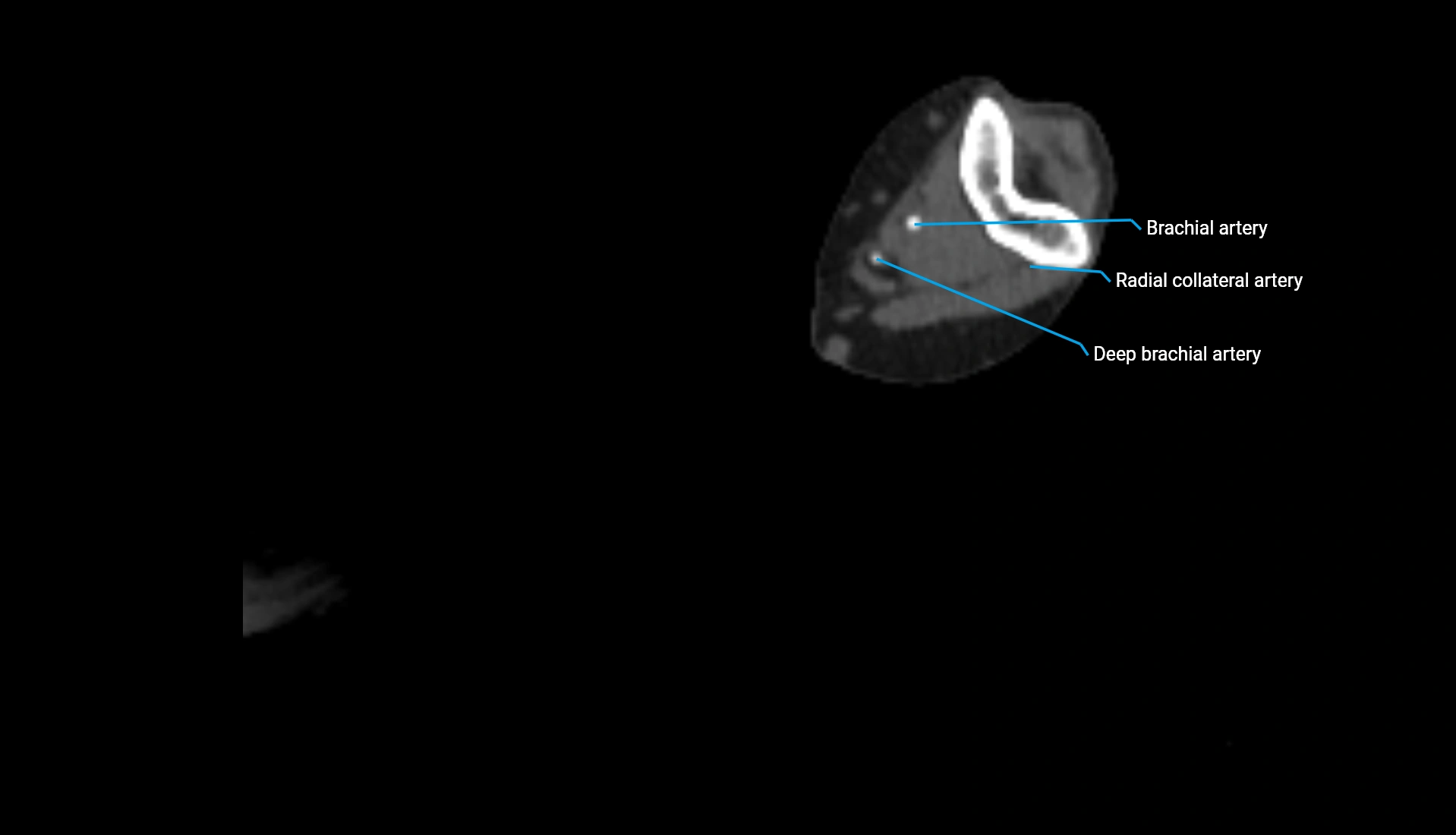 CTA upper limb axial cross sectional anatomy labelled image 198 (2).webp